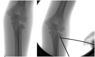 Wrestling Elbow Fracture