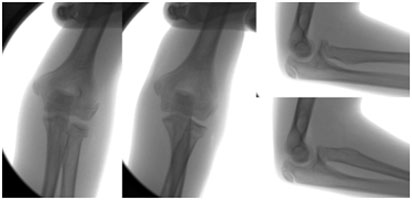 Wrestling Elbow Fracture