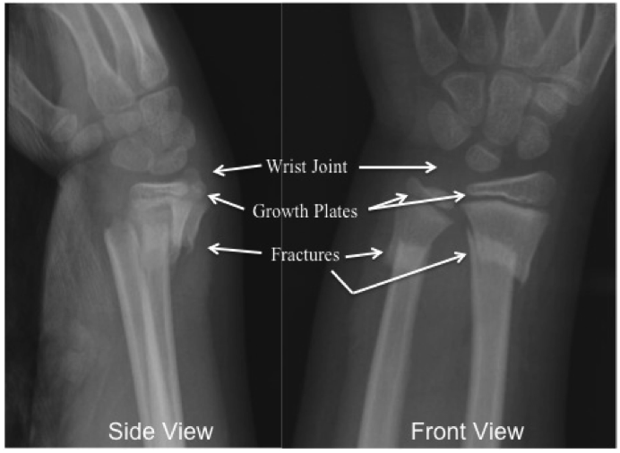 Pediatric Wrist Fractures