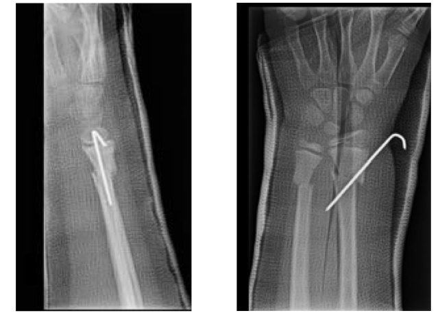 Pediatric Wrist Fractures