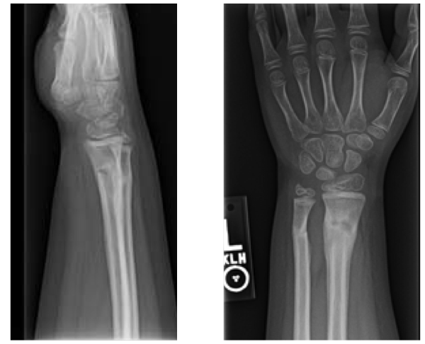 Pediatric Wrist Fractures